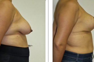 Mastopexy-05-scaled