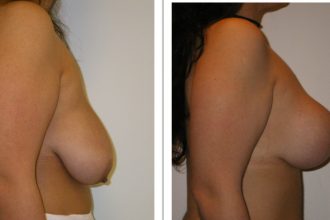 Mastopexy-06-scaled