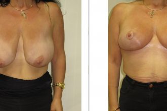 Mastopexy-07-scaled