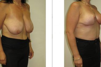 Mastopexy-08-scaled