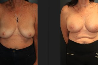 Mastopexy-15