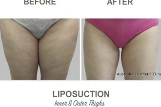 Thigh-Liposuction-Dr-Mark-Kohout-2-7