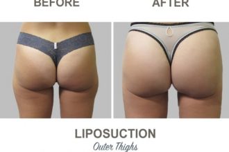 Thigh-Liposuction-Dr-Mark-Kohout-4-2