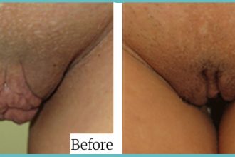 labioplasty-01