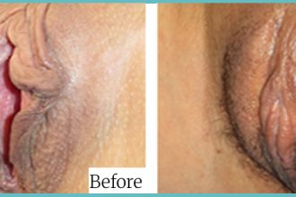 labioplasty-03
