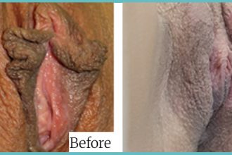 labioplasty-06